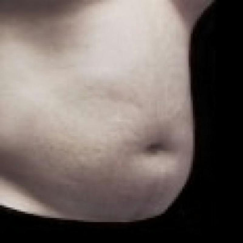 SAFElipo Before & After Gallery - Patient 208761 - Image 3