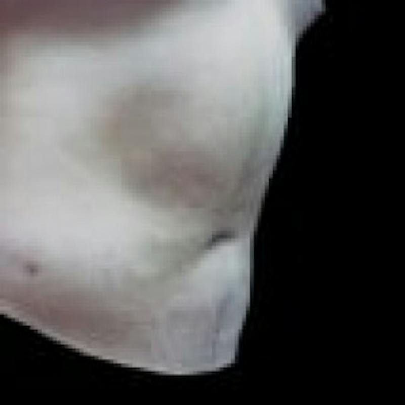 SAFElipo Before & After Gallery - Patient 208761 - Image 4