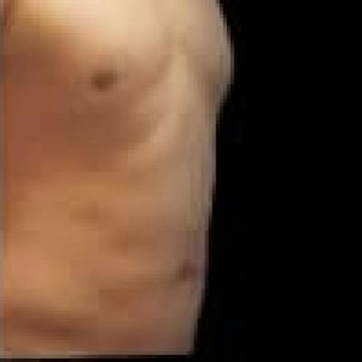 SAFElipo Before & After Gallery - Patient 138305 - Image 2
