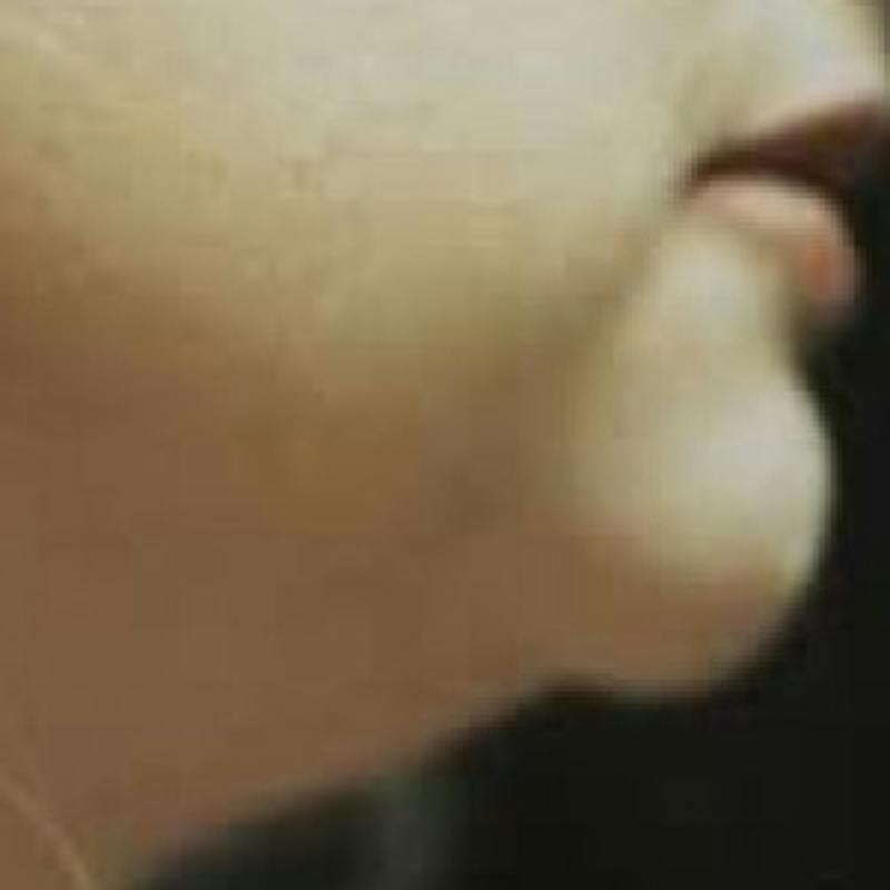 SAFElipo Before & After Gallery - Patient 339494 - Image 1