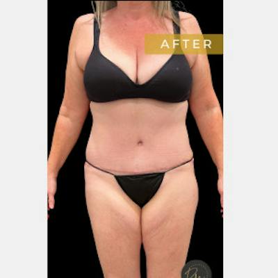 Mini Abdominoplasty Before & After Gallery - Patient 367931 - Image 2