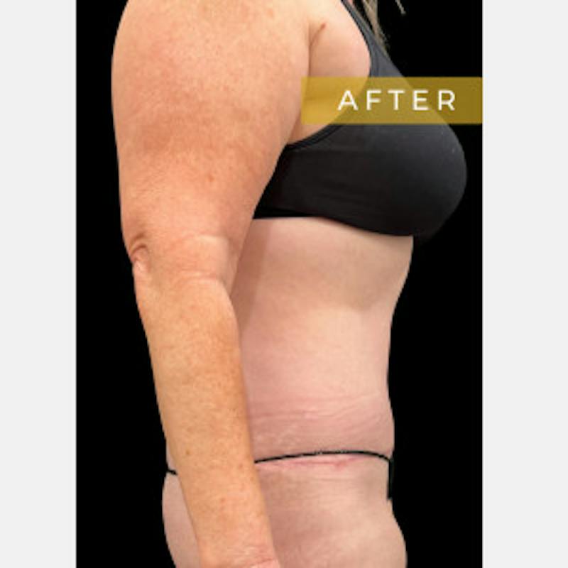 SAFElipo Before & After Gallery - Patient 387575 - Image 4