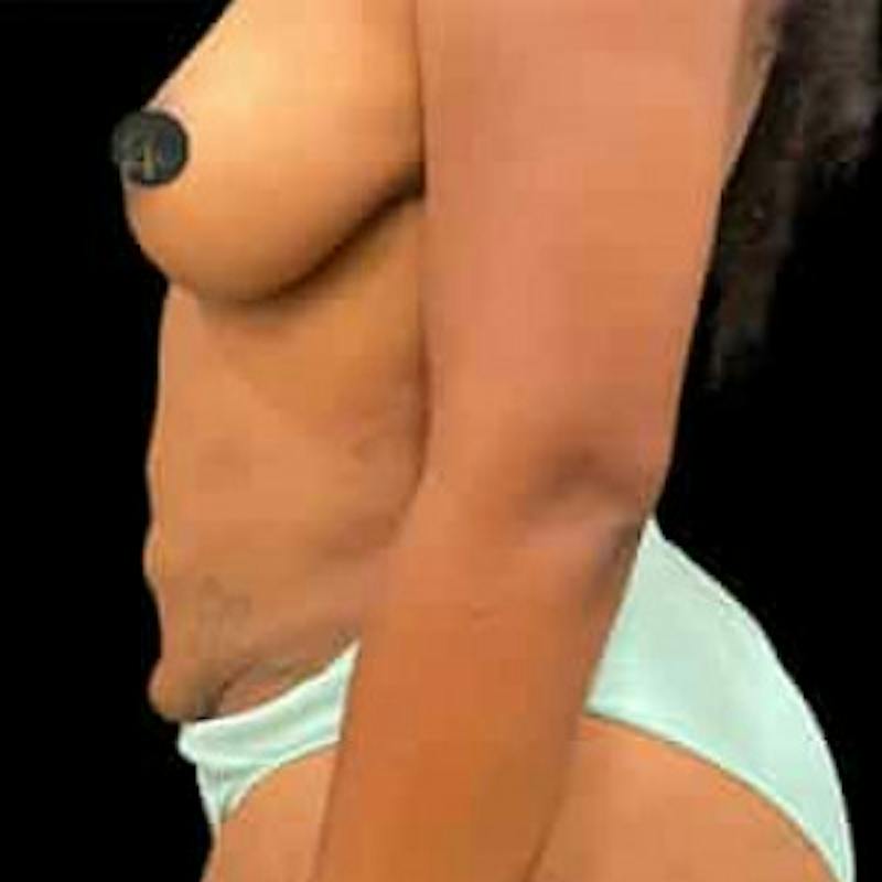 Mini Abdominoplasty Before & After Gallery - Patient 320565 - Image 1