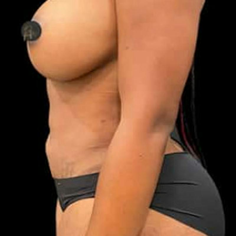 Mini Abdominoplasty Before & After Gallery - Patient 320565 - Image 2