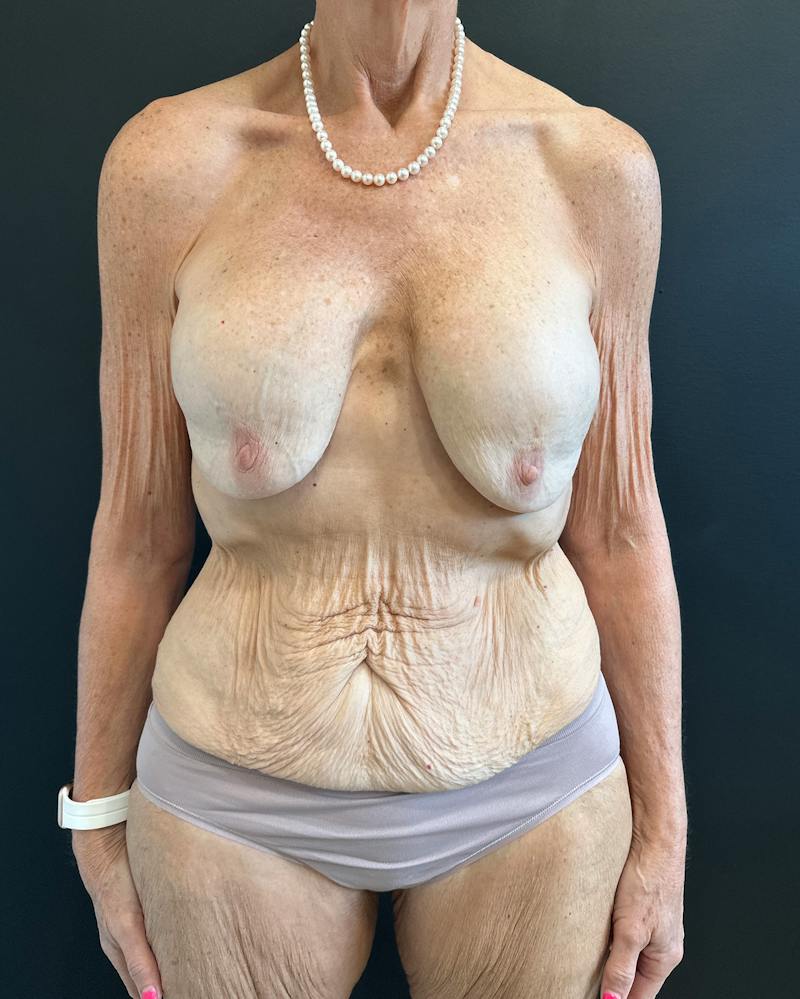 Mommy Makeover Before & After Gallery - Patient 214811 - Image 1