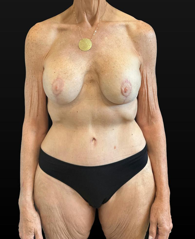 Mommy Makeover Before & After Gallery - Patient 214811 - Image 2