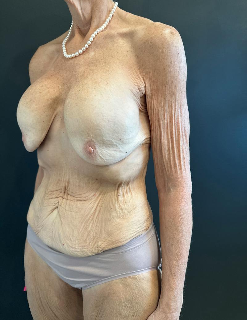 Mommy Makeover Before & After Gallery - Patient 214811 - Image 3