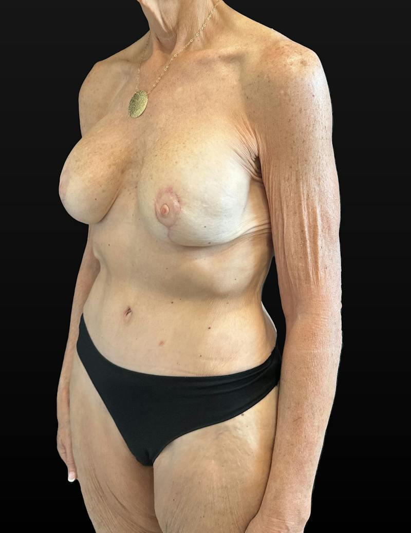 Mommy Makeover Before & After Gallery - Patient 214811 - Image 4