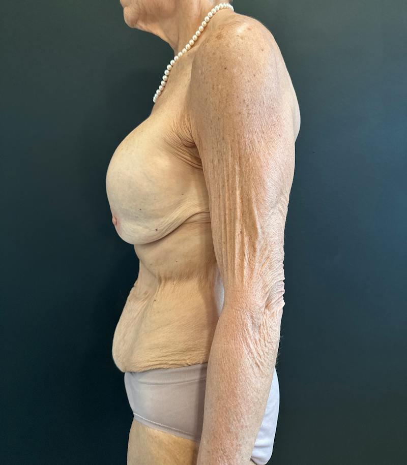 Mommy Makeover Before & After Gallery - Patient 214811 - Image 5