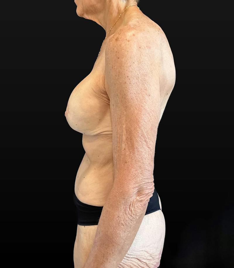 Mommy Makeover Before & After Gallery - Patient 214811 - Image 6