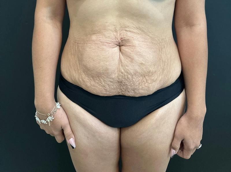 Abdominoplasty (Tummy Tuck) Before & After Gallery - Patient 411168 - Image 1