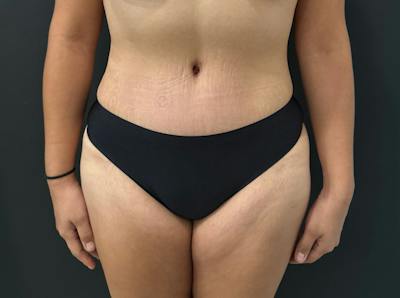 SAFElipo Before & After Gallery - Patient 143911 - Image 2