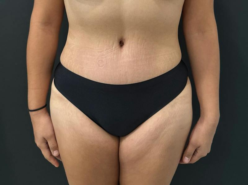 Abdominoplasty (Tummy Tuck) Before & After Gallery - Patient 411168 - Image 2