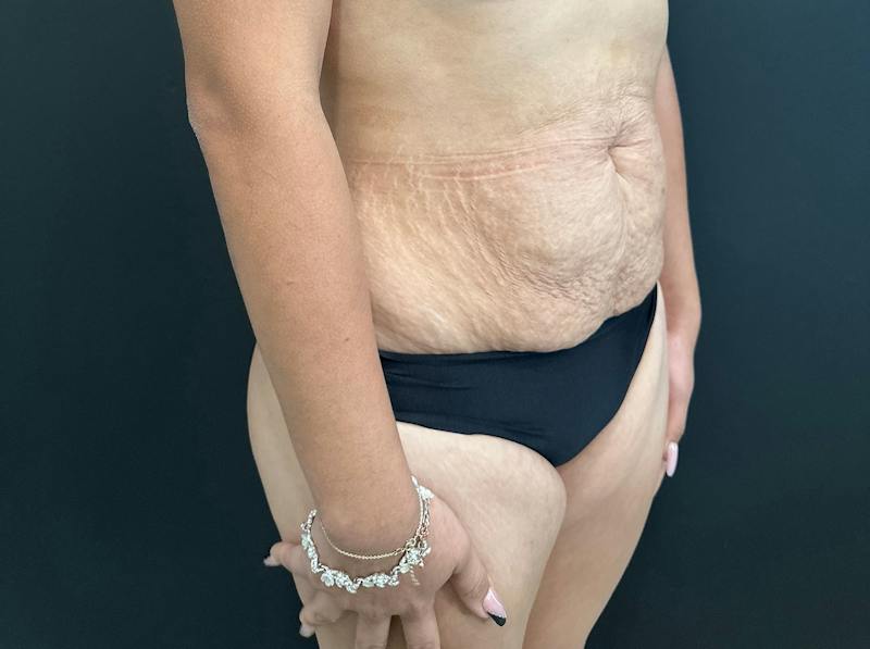 Abdominoplasty (Tummy Tuck) Before & After Gallery - Patient 411168 - Image 3