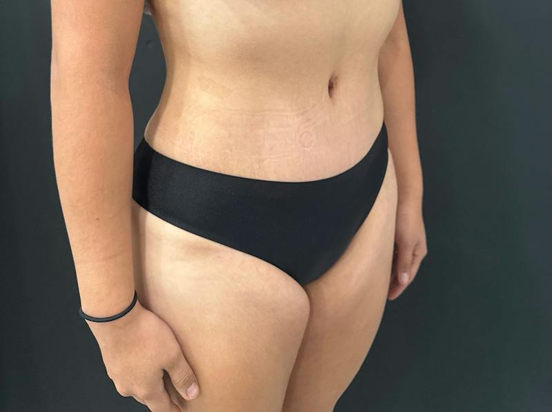 Abdominoplasty (Tummy Tuck) Before & After Gallery - Patient 411168 - Image 4