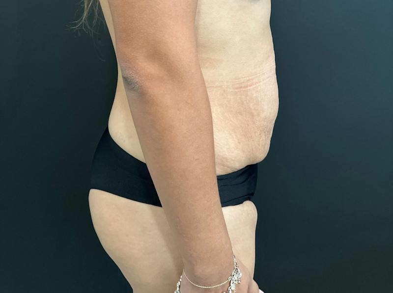 Abdominoplasty (Tummy Tuck) Before & After Gallery - Patient 411168 - Image 5
