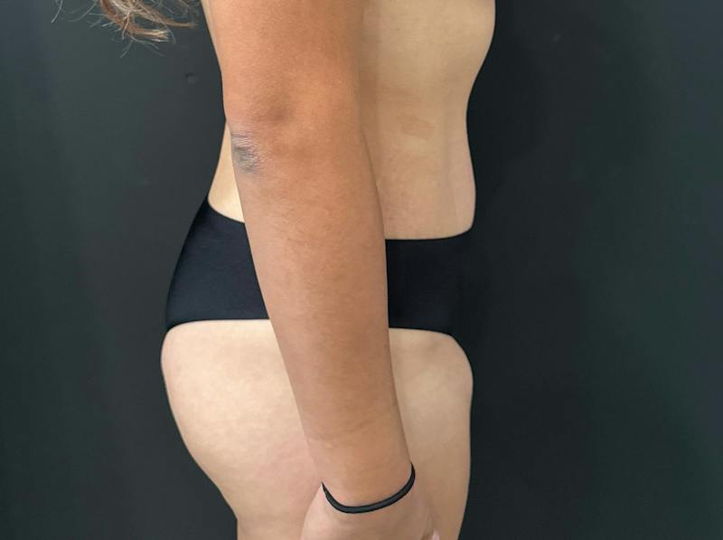 Abdominoplasty (Tummy Tuck) Before & After Gallery - Patient 411168 - Image 6