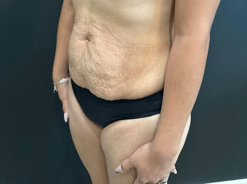 Abdominoplasty (Tummy Tuck) Before & After Gallery - Patient 411168 - Image 7