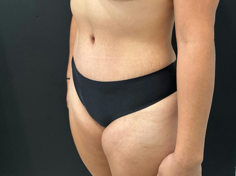 Abdominoplasty (Tummy Tuck) Before & After Gallery - Patient 411168 - Image 8