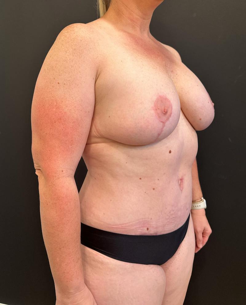 Mommy Makeover Before & After Gallery - Patient 455455 - Image 4