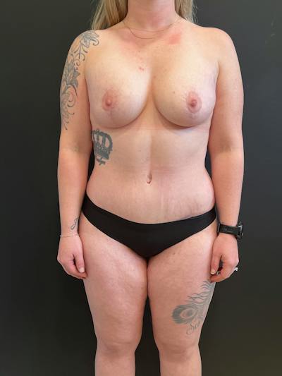 Mommy Makeover Before & After Gallery - Patient 277931 - Image 2