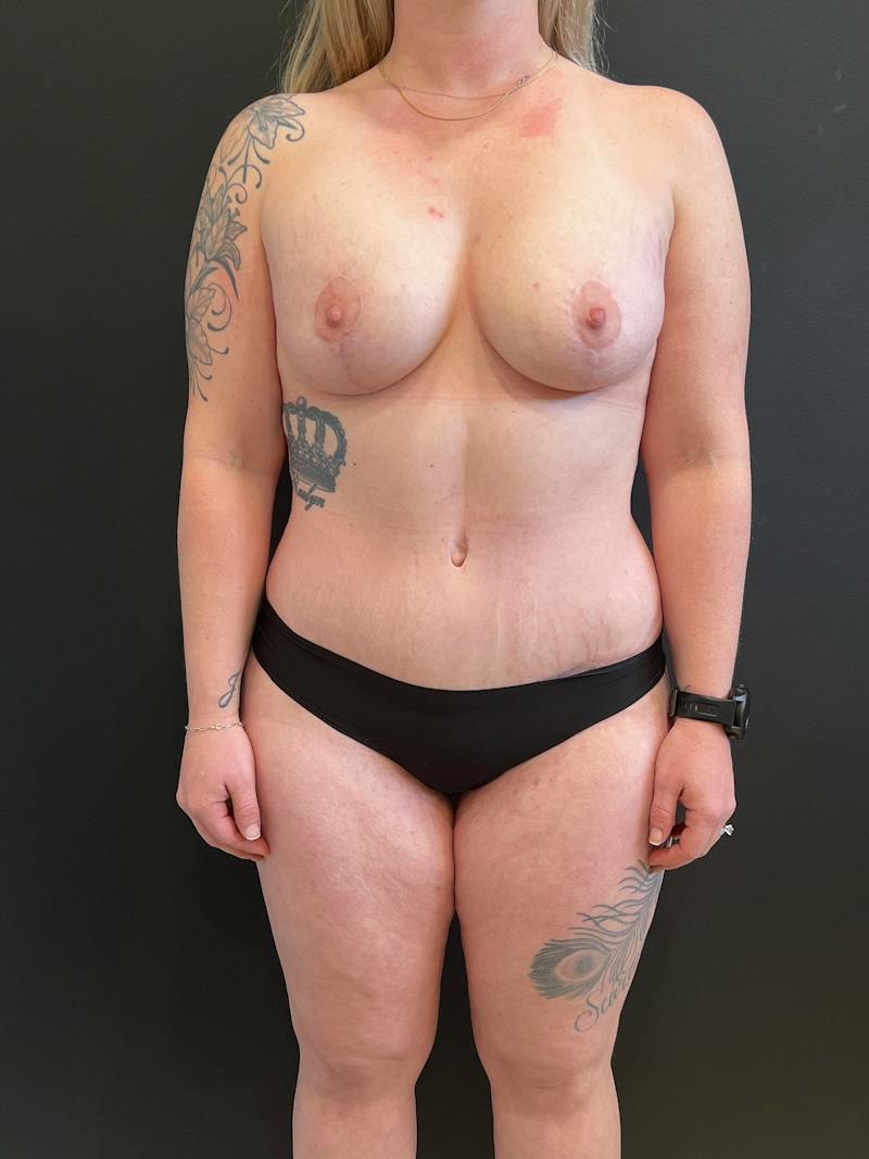 Mommy Makeover Before & After Gallery - Patient 277931 - Image 2
