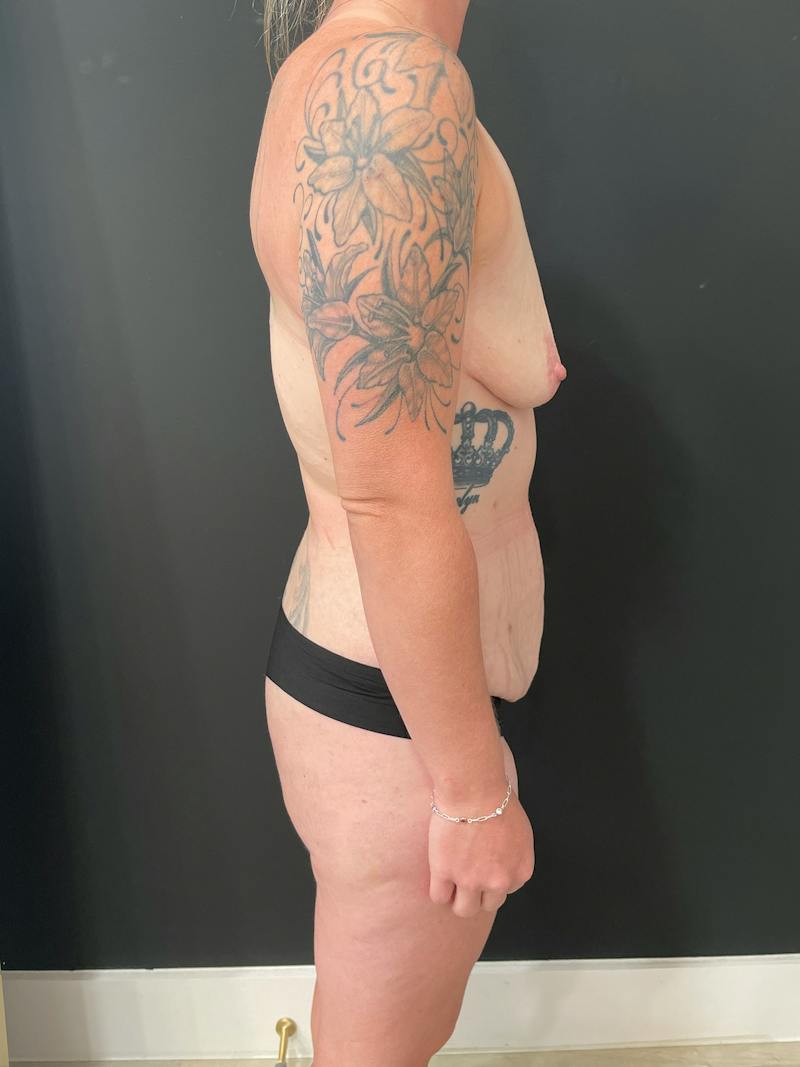 Mommy Makeover Before & After Gallery - Patient 277931 - Image 5