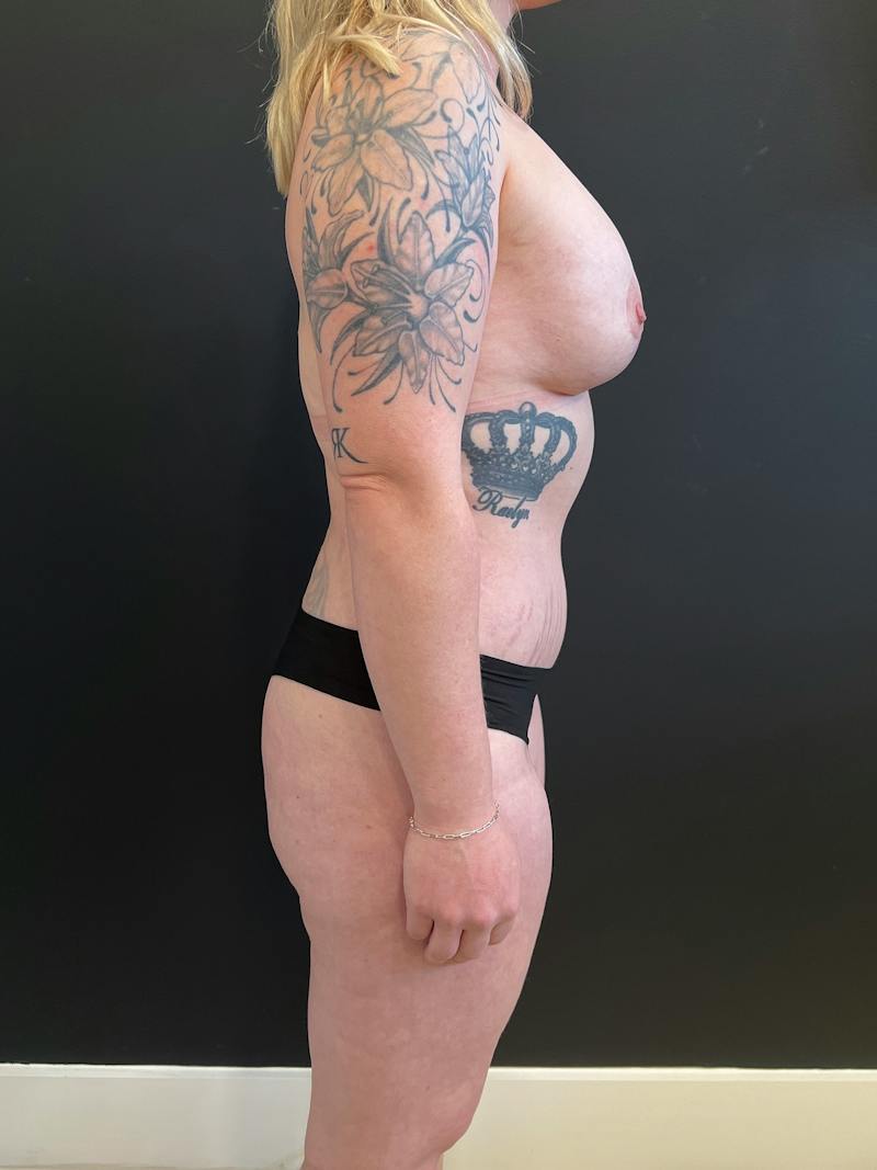 Mommy Makeover Before & After Gallery - Patient 277931 - Image 6