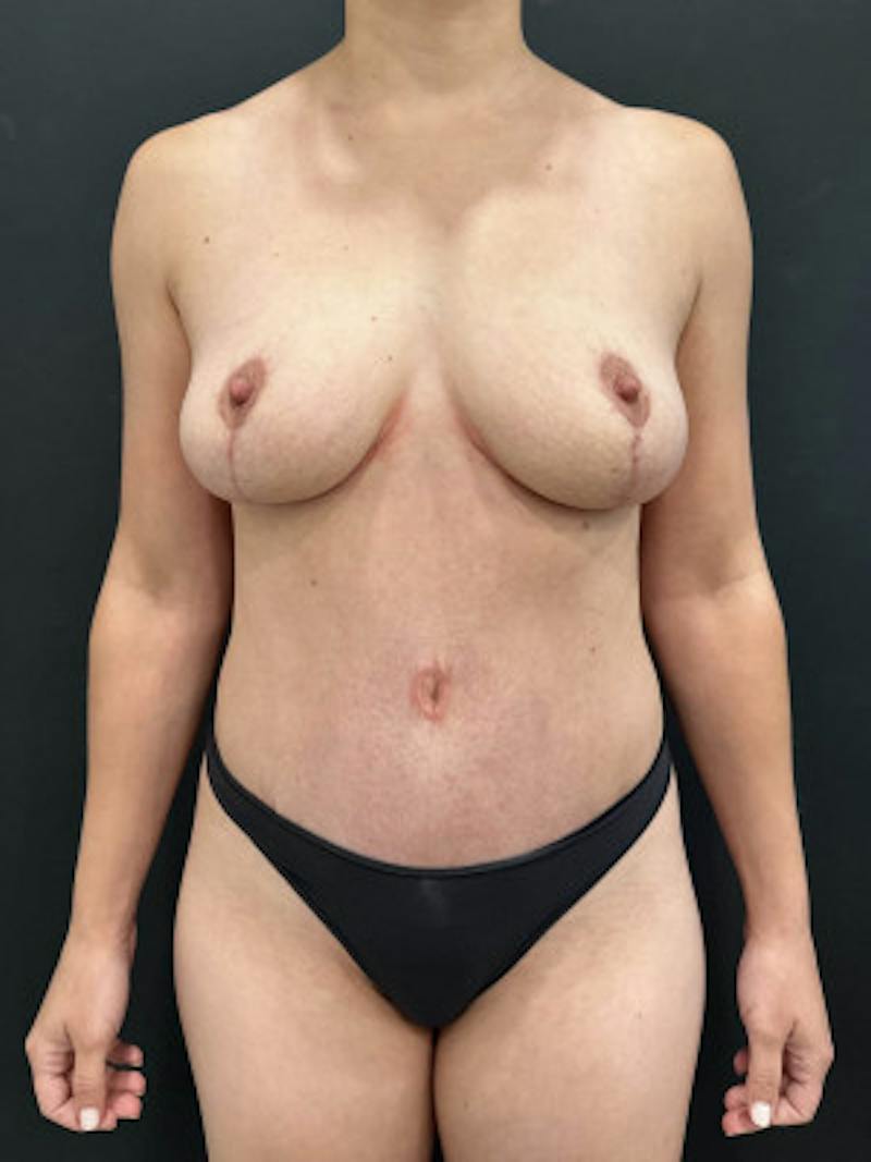 Mommy Makeover Before & After Gallery - Patient 353404 - Image 2
