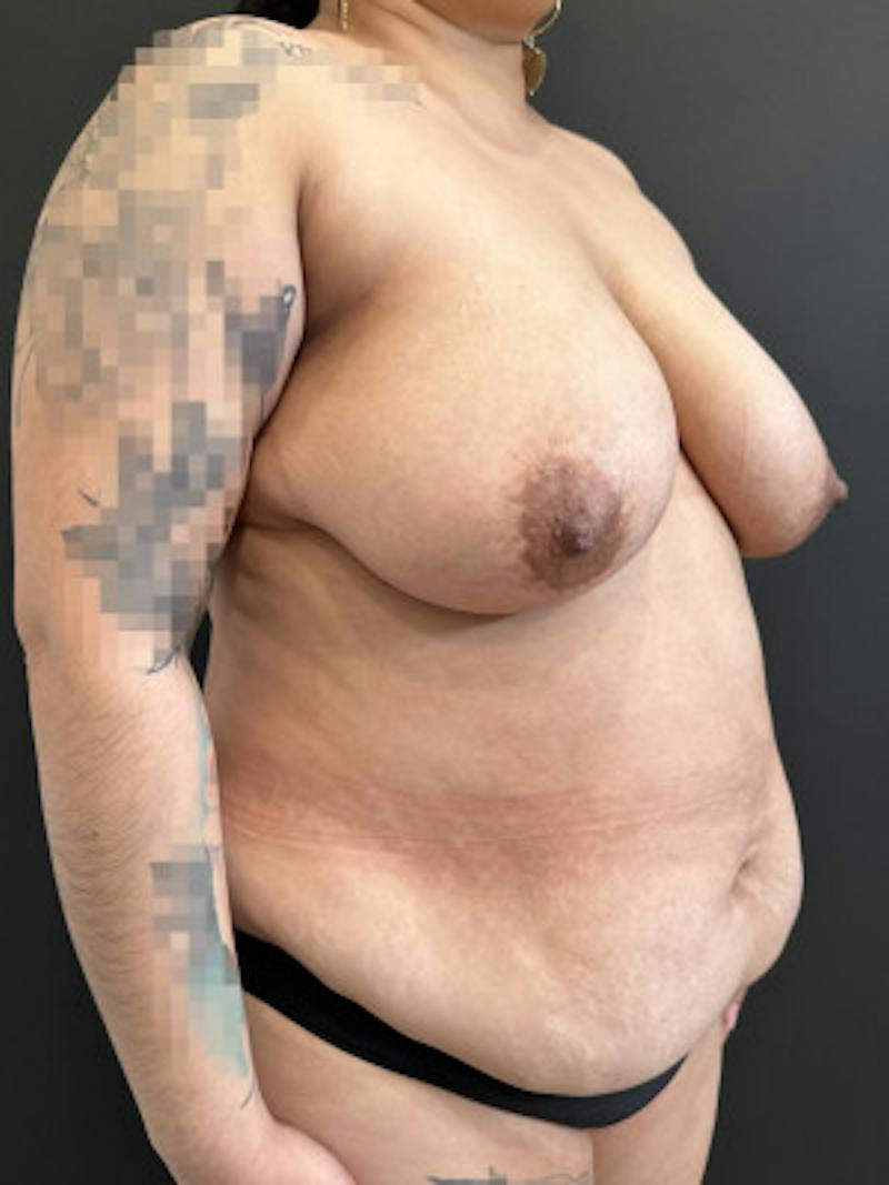 Mommy Makeover Before & After Gallery - Patient 377806 - Image 3