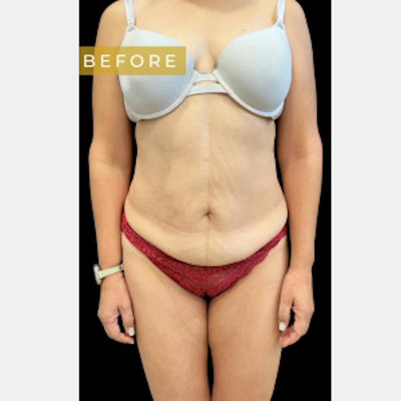 Mommy Makeover Before & After Gallery - Patient 374540 - Image 1