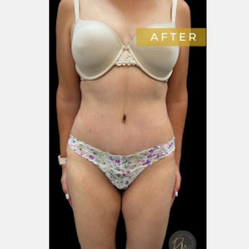Mommy Makeover Before & After Gallery - Patient 374540 - Image 2