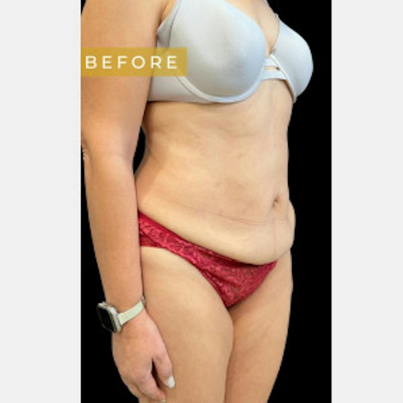 Mommy Makeover Before & After Gallery - Patient 374540 - Image 3