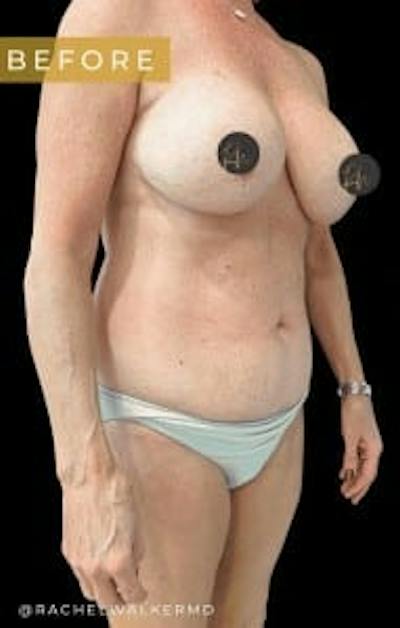 Abdominoplasty (Tummy Tuck) Before & After Gallery - Patient 234736 - Image 1