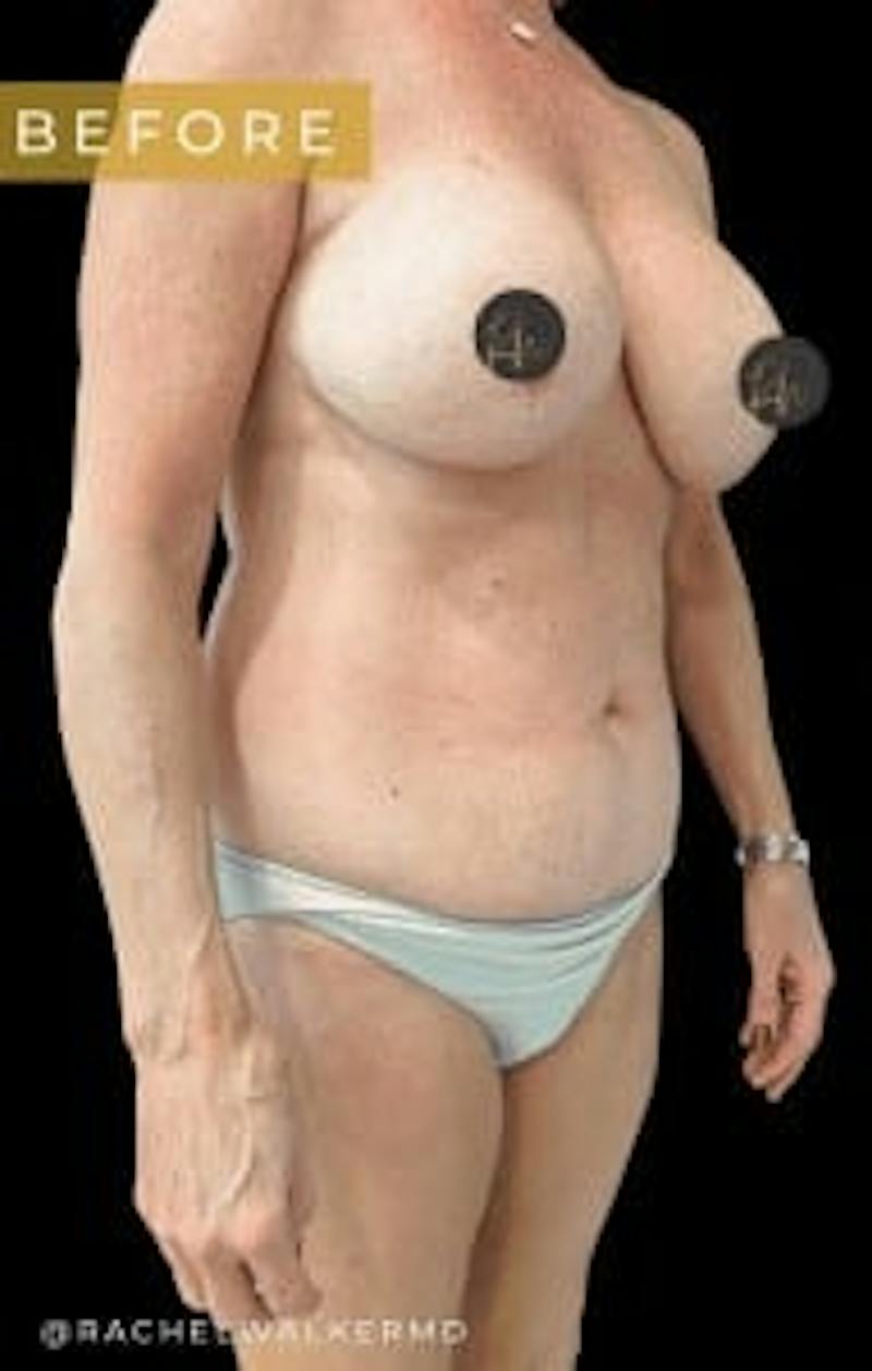 Mommy Makeover Before & After Gallery - Patient 106980 - Image 1