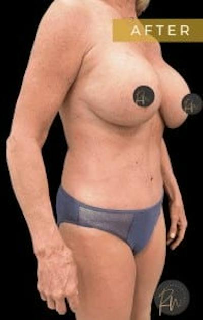 Abdominoplasty (Tummy Tuck) Before & After Gallery - Patient 234736 - Image 2