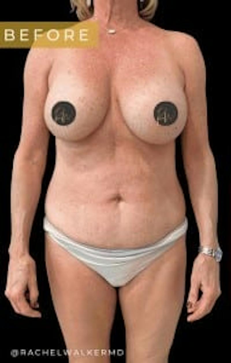 Mommy Makeover Before & After Gallery - Patient 106980 - Image 3