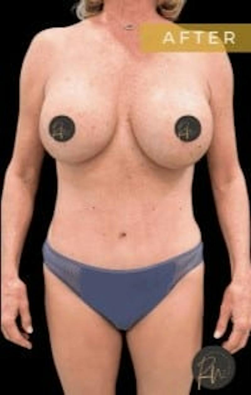 Mommy Makeover Before & After Gallery - Patient 106980 - Image 4