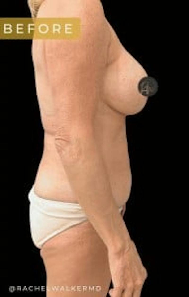 Mommy Makeover Before & After Gallery - Patient 106980 - Image 5