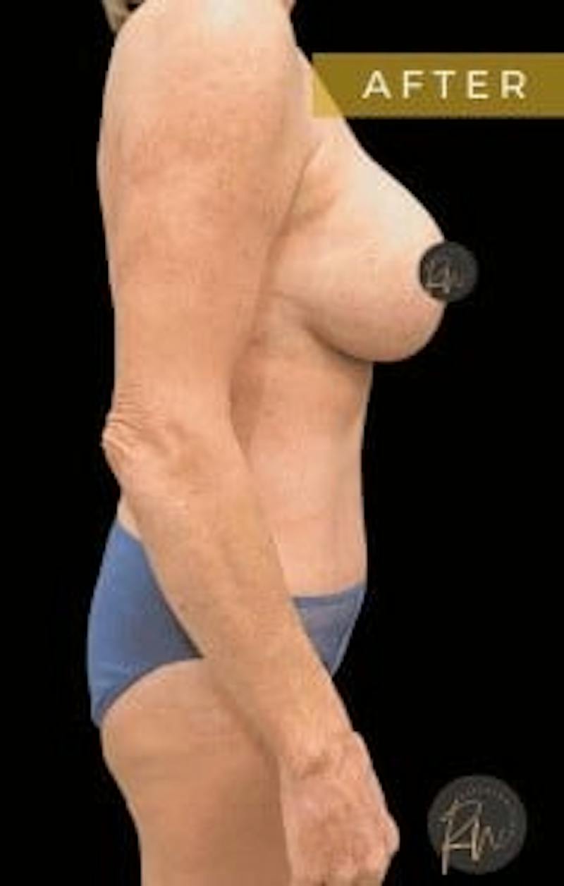 Mommy Makeover Before & After Gallery - Patient 106980 - Image 6