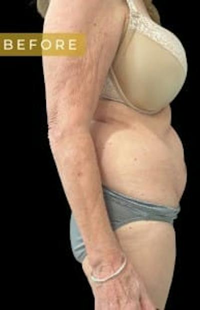 Abdominoplasty (Tummy Tuck) Before & After Gallery - Patient 357956 - Image 1