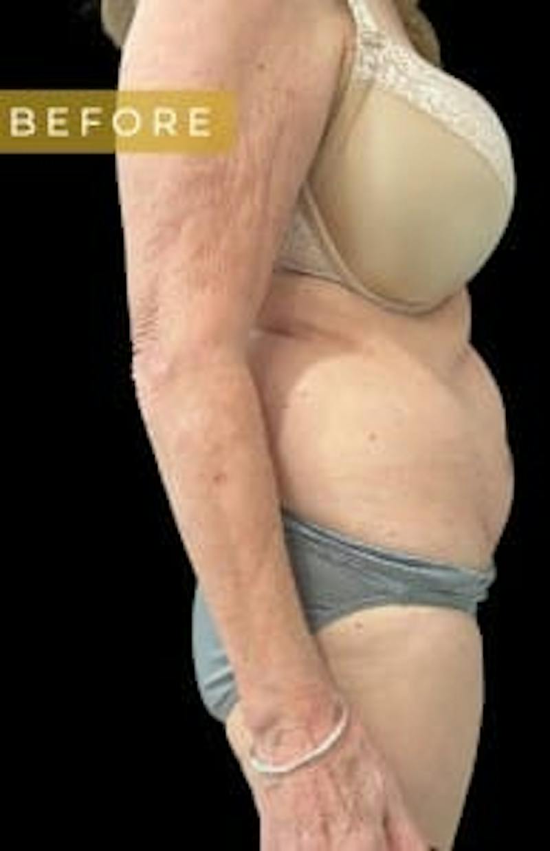 SAFElipo Before & After Gallery - Patient 386053 - Image 1
