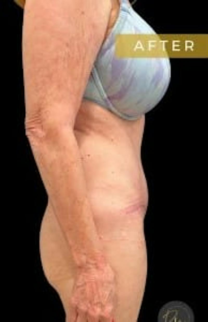 SAFElipo Before & After Gallery - Patient 386053 - Image 2