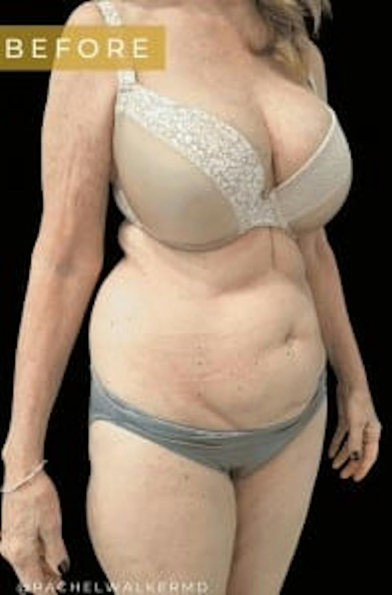 SAFElipo Before & After Gallery - Patient 386053 - Image 3