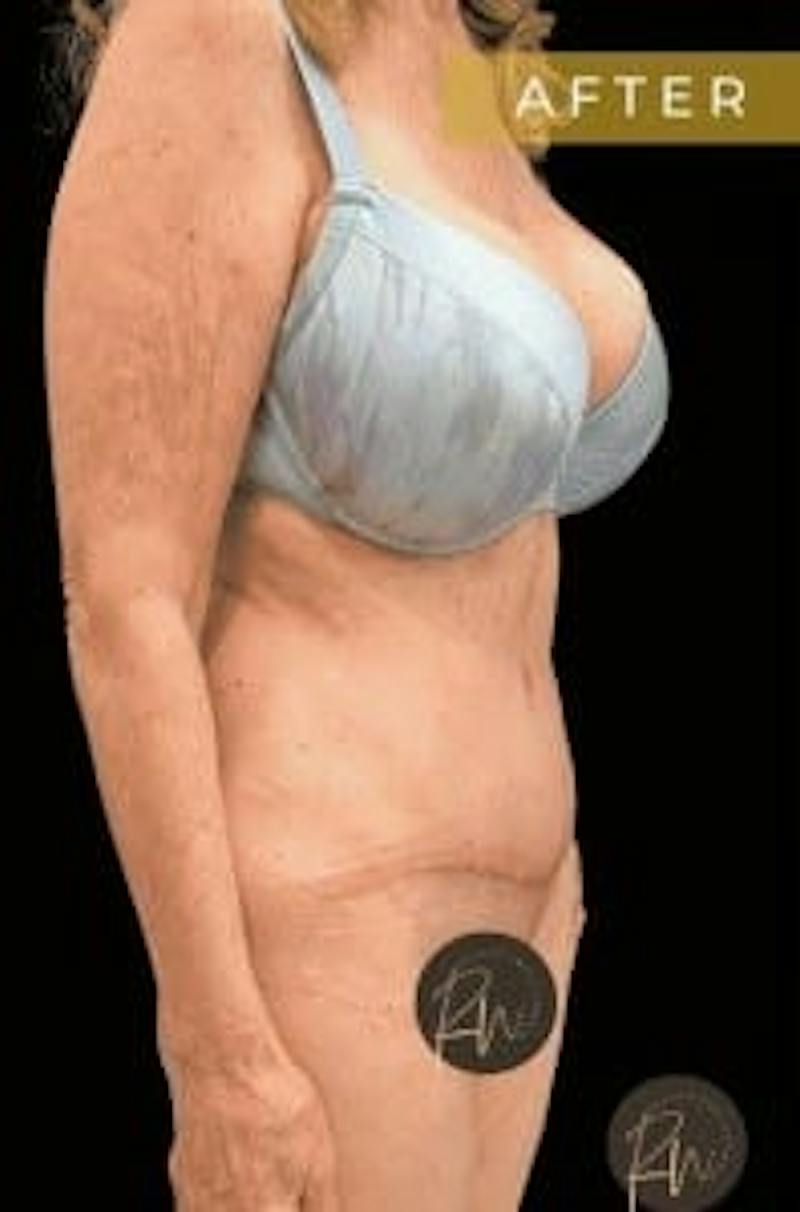 SAFElipo Before & After Gallery - Patient 386053 - Image 4