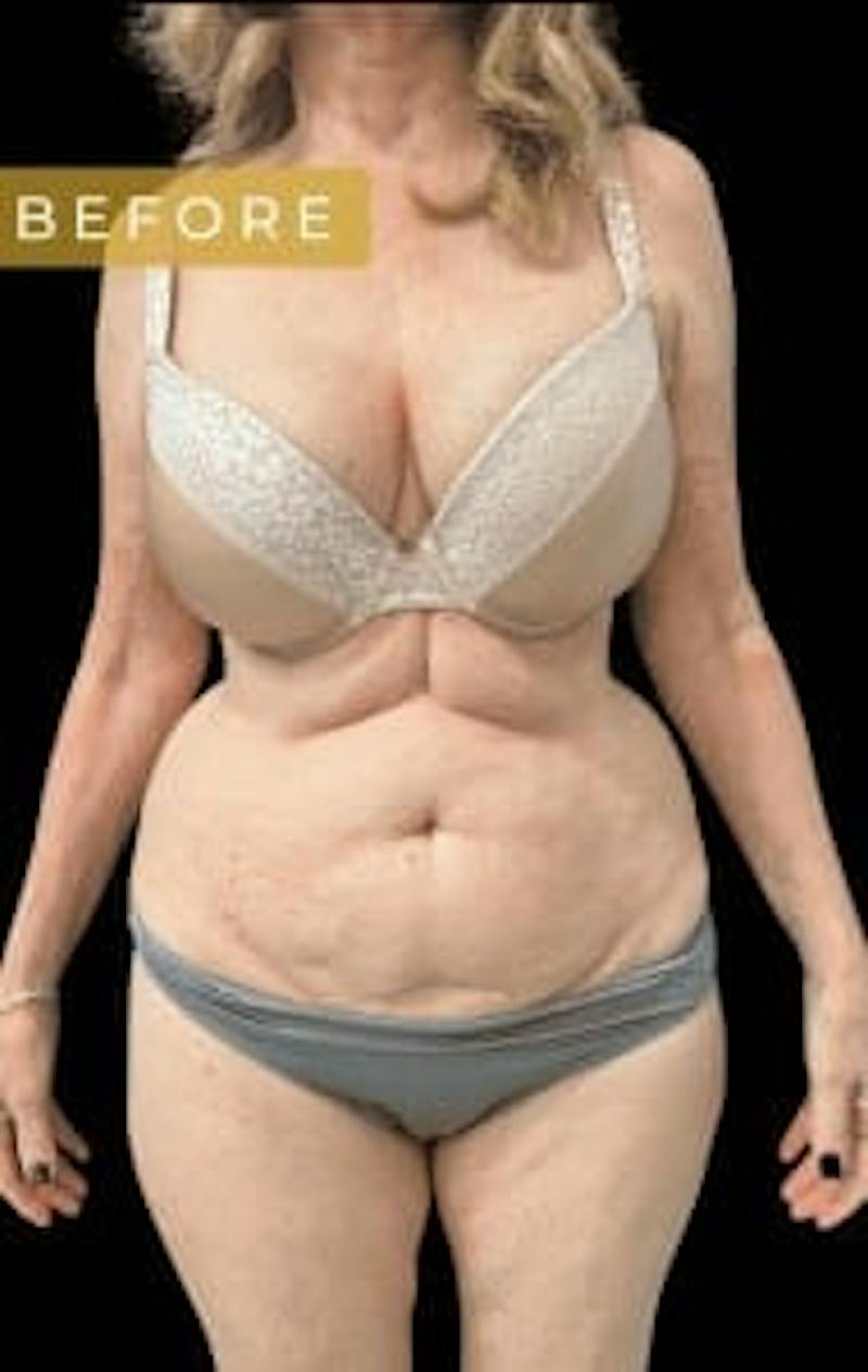 SAFElipo Before & After Gallery - Patient 386053 - Image 5