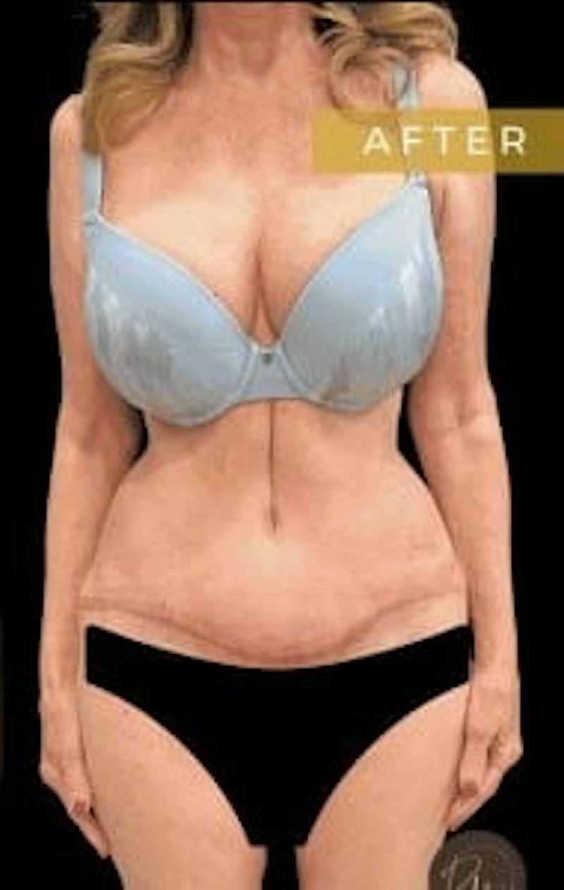 SAFElipo Before & After Gallery - Patient 386053 - Image 6