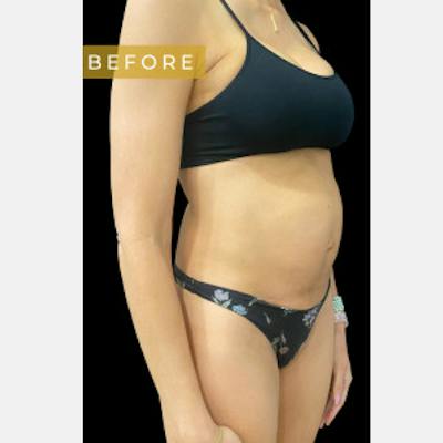 Abdominoplasty (Tummy Tuck) Before & After Gallery - Patient 143833 - Image 1