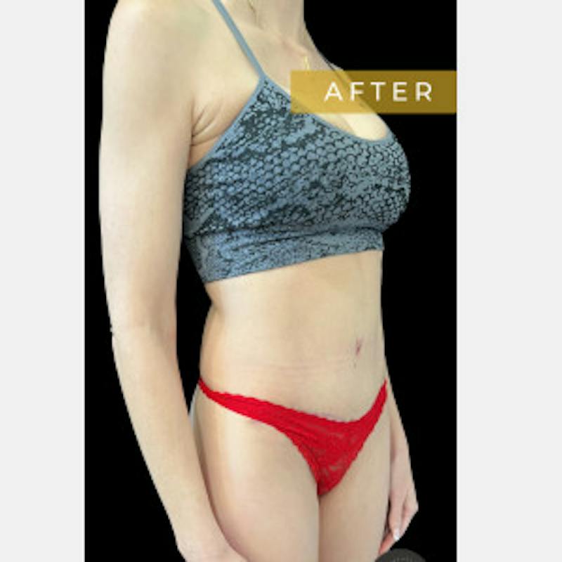 Mommy Makeover Before & After Gallery - Patient 142841 - Image 2