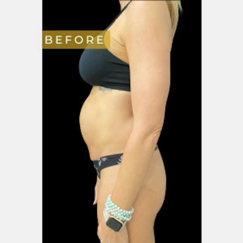 Mommy Makeover Before & After Gallery - Patient 142841 - Image 3